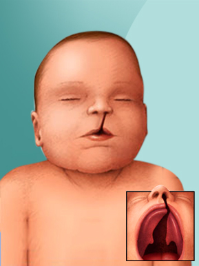 Facial Clefts And 119