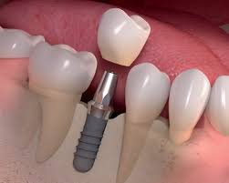 dental-implant-thrissur