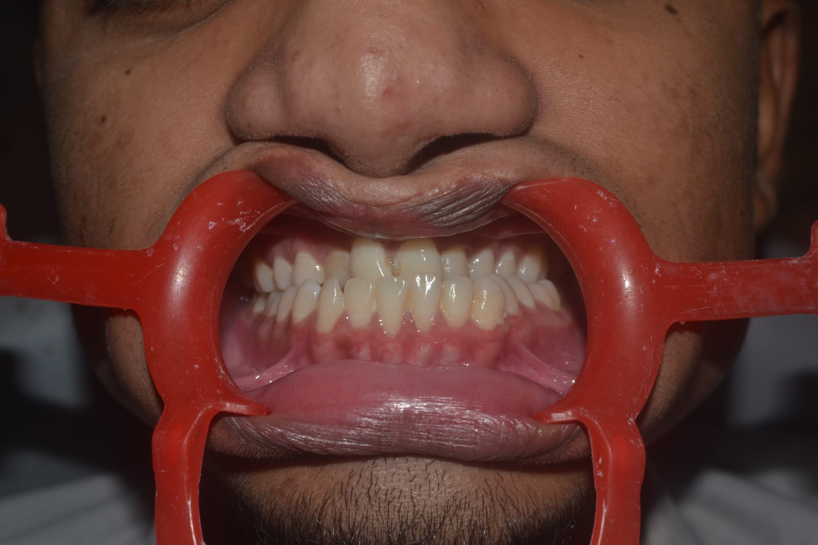 Maxillary Surgery Result