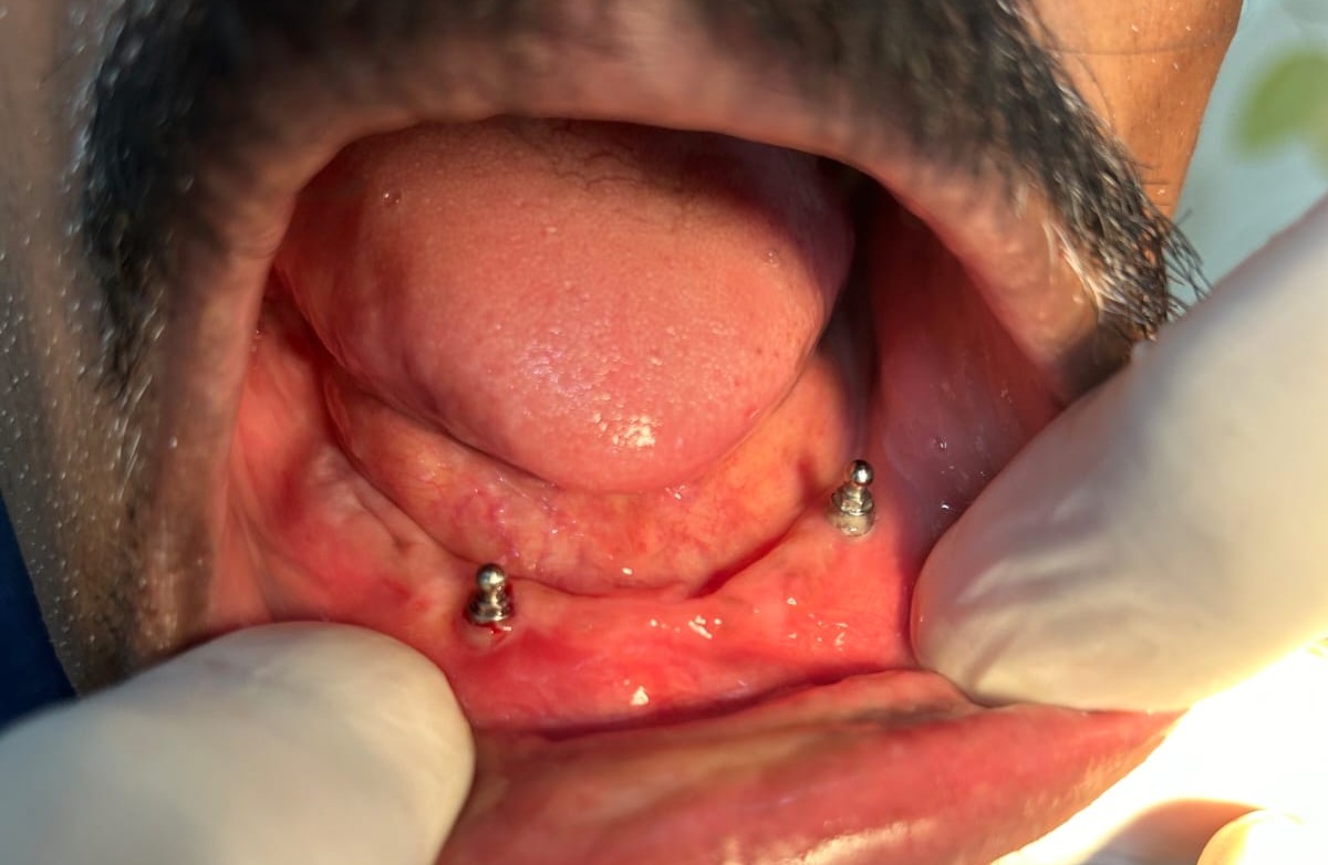 Orthognathic Surgery Procedure