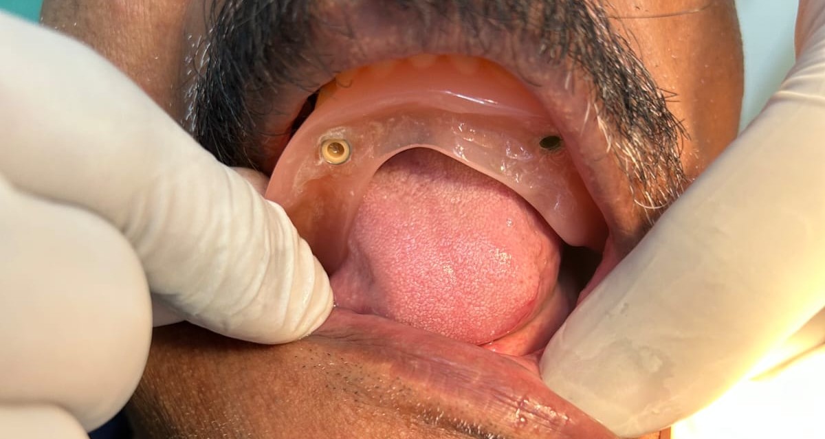 Maxillary Surgery Result