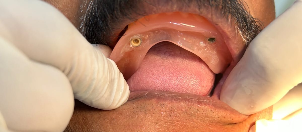 Maxillary Surgery Result
