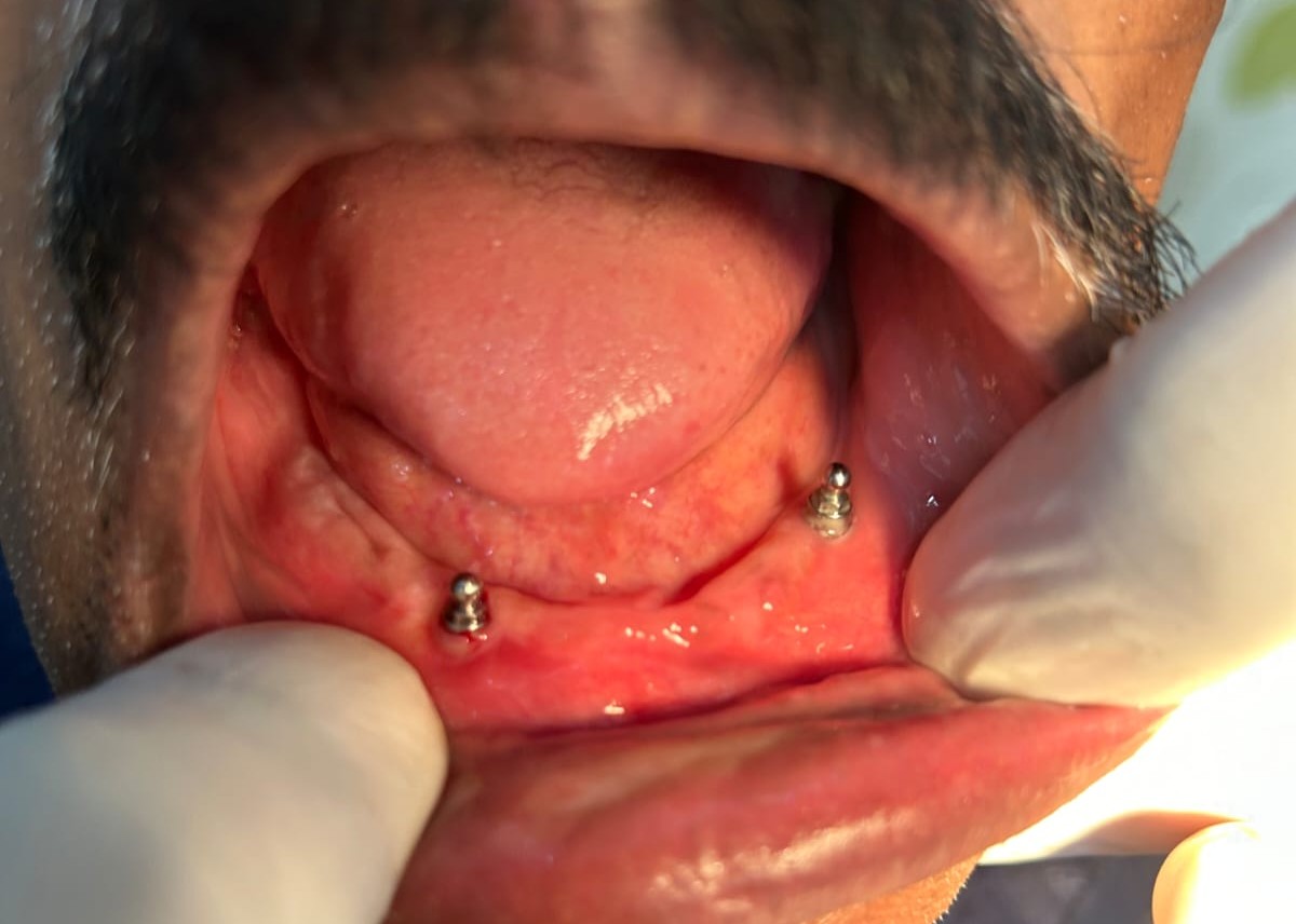 Maxillary Surgery Result