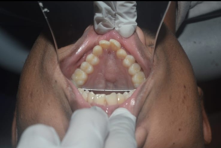 Maxillary Prognathism Treatment