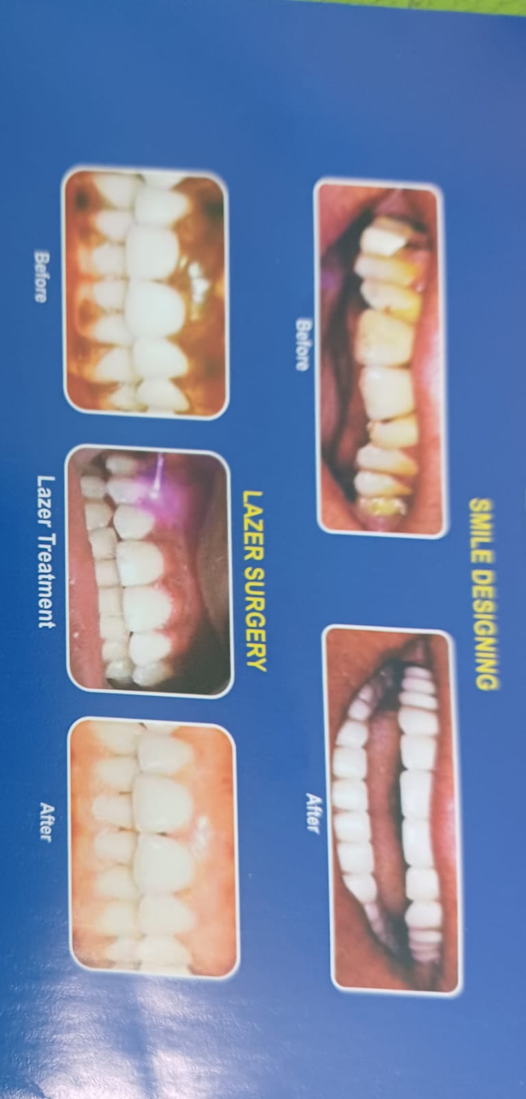 Maxillary Prognathism Treatment