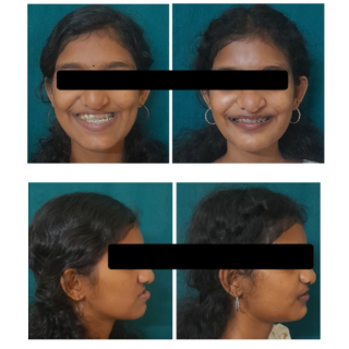 Orthognathic Surgery Procedure
