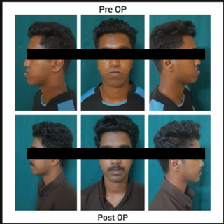 Maxillary Prognathism Treatment