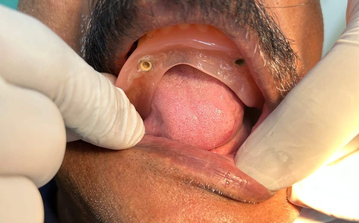 Orthognathic Surgery Procedure