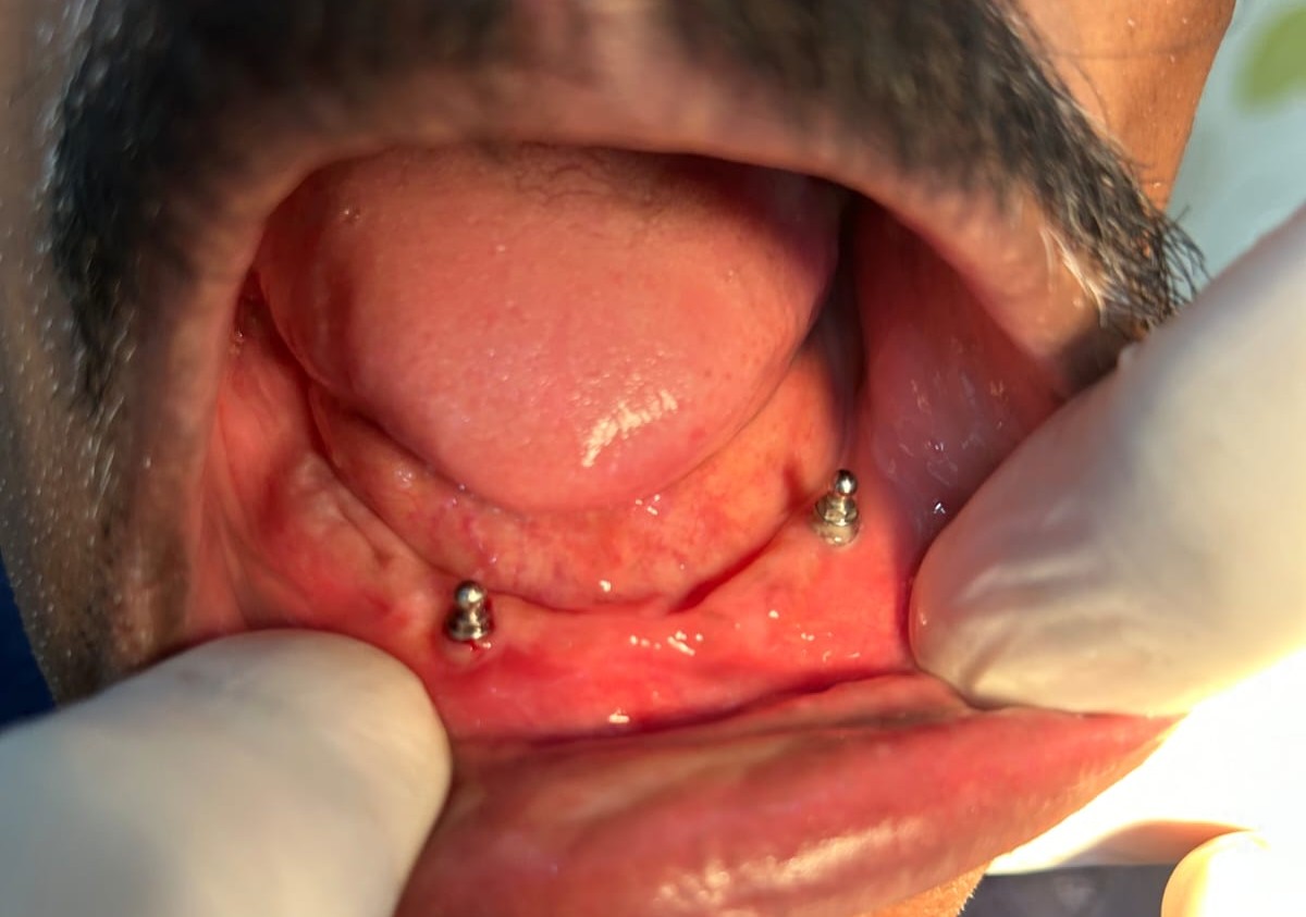 Jaw Correction Surgery