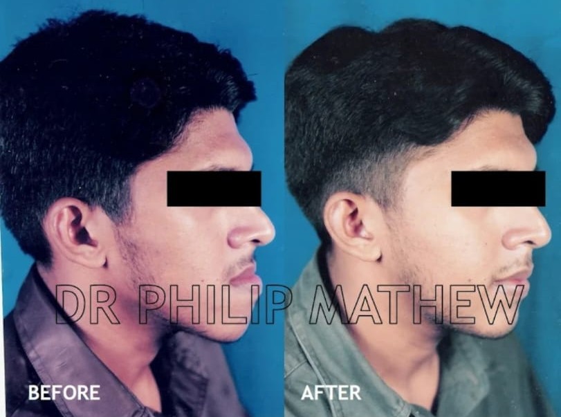 Orthognathic Surgery Procedure