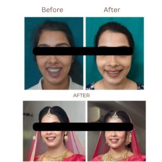 Maxillary Prognathism(Upper Jaw Deformity)