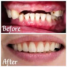 Removable Prosthodontics