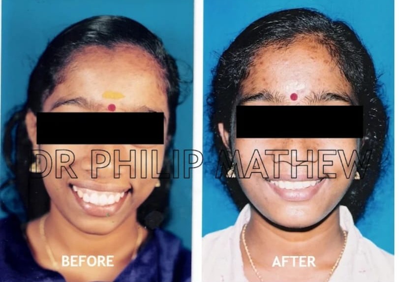 Jaw Contouring / Jaw Repair