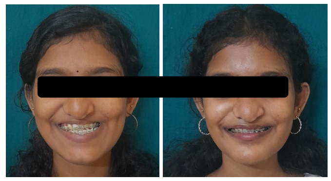Deficient midface