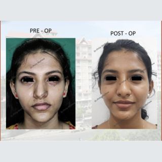 Facial Asymmetry Correction