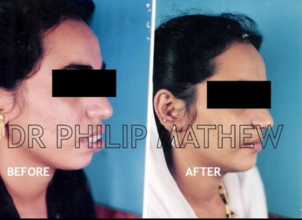 Maxillary Prognathism(Upper Jaw Deformity)