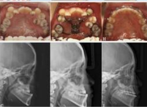 Maxillary Prognathism(Upper Jaw Deformity)