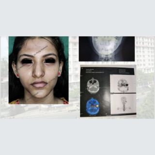 Facial Asymmetry Correction