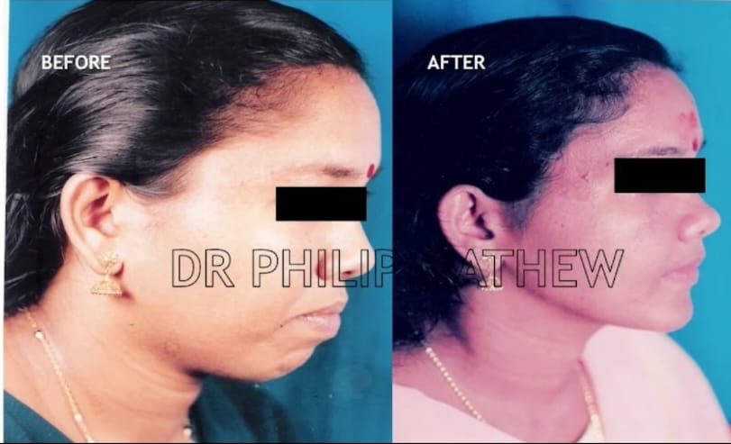 Maxillary Prognathism(Upper Jaw Deformity)