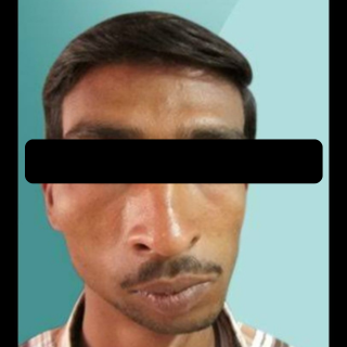 Facial Asymmetry Correction