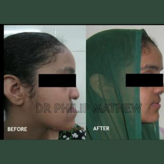 Jaw Contouring / Jaw Repair