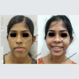 Facial Asymmetry Correction