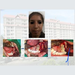 Facial Asymmetry Correction