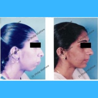 Maxillary Prognathism(Upper Jaw Deformity)