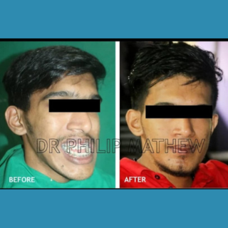 Jaw Contouring / Jaw Repair