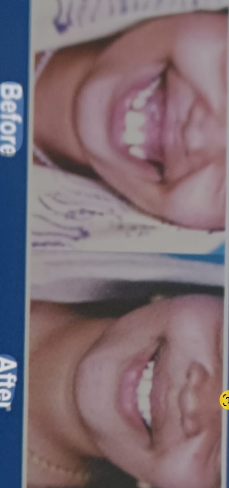 Maxillary Prognathism(Upper Jaw Deformity)