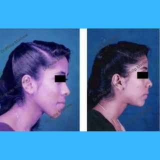 Maxillary Prognathism(Upper Jaw Deformity)