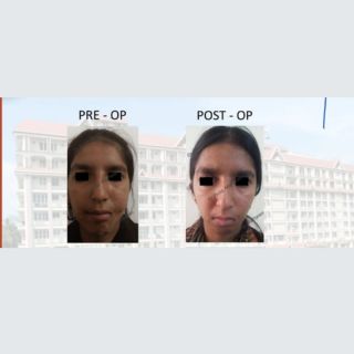 Facial Asymmetry Correction