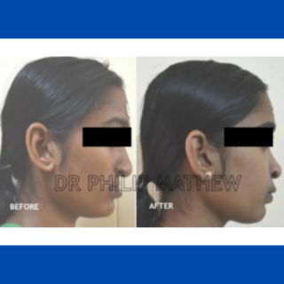 Maxillary Prognathism(Upper Jaw Deformity)