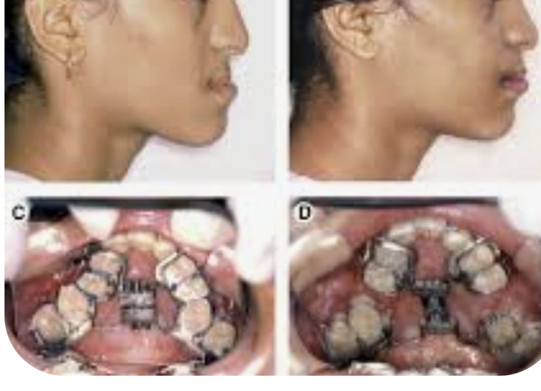 Maxillary Hypoplasia