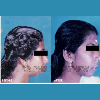 Maxillary Prognathism(Upper Jaw Deformity)