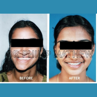 Jaw Contouring / Jaw Repair