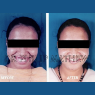 Maxillary Prognathism(Upper Jaw Deformity)