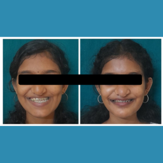 Jaw Contouring / Jaw Repair