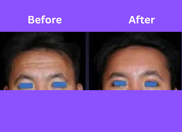 Forehead Lifting