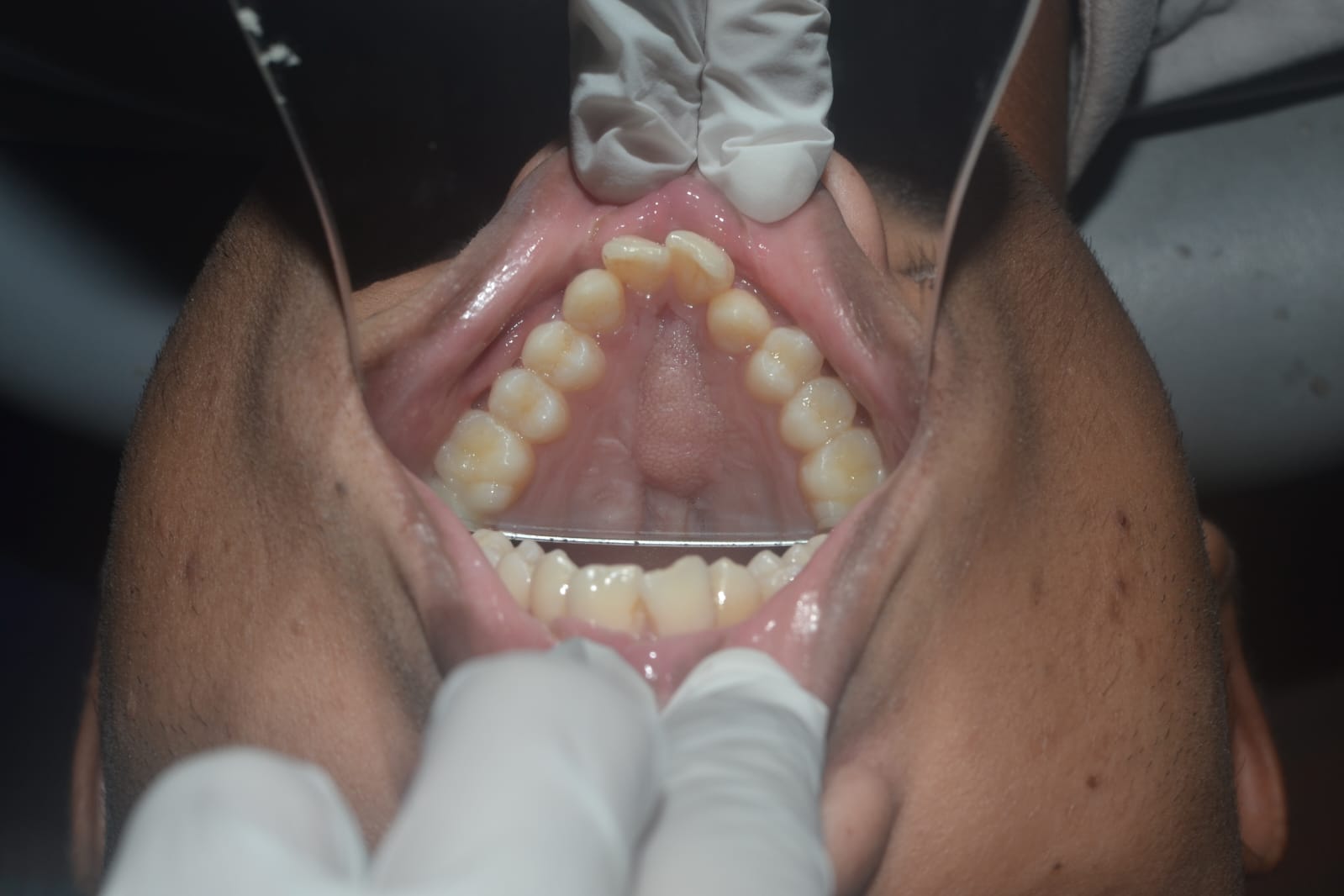 Obstructive sleep apnoea