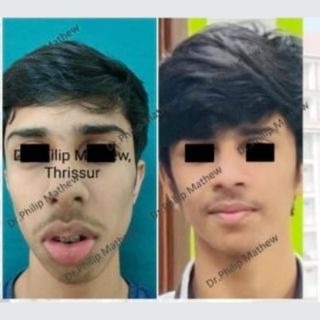 Orthognathic Surgery