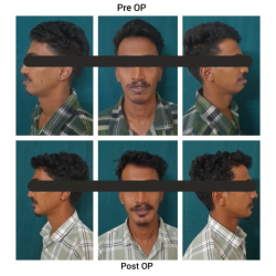 Orthognathic Surgery