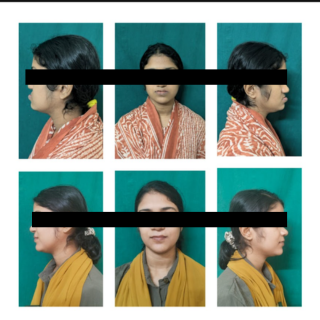 Cleft lip and Palate Treatment