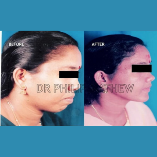 Orthognathic Surgery