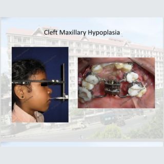 Cleft lip and Palate Treatment