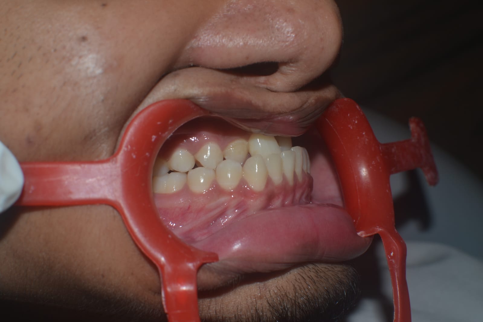 Orthognathic Surgery