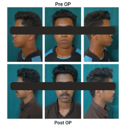 Orthognathic Surgery