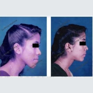 Orthognathic Surgery