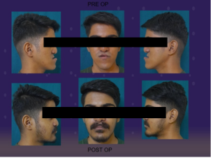 Cleft lip and Palate Treatment