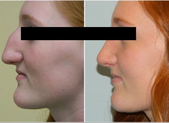 Rhinoplasty Surgery